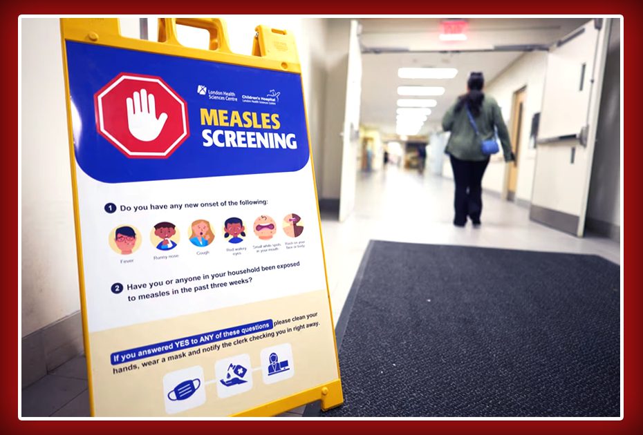 کینیڈا اور امریکہ میں خسرہ