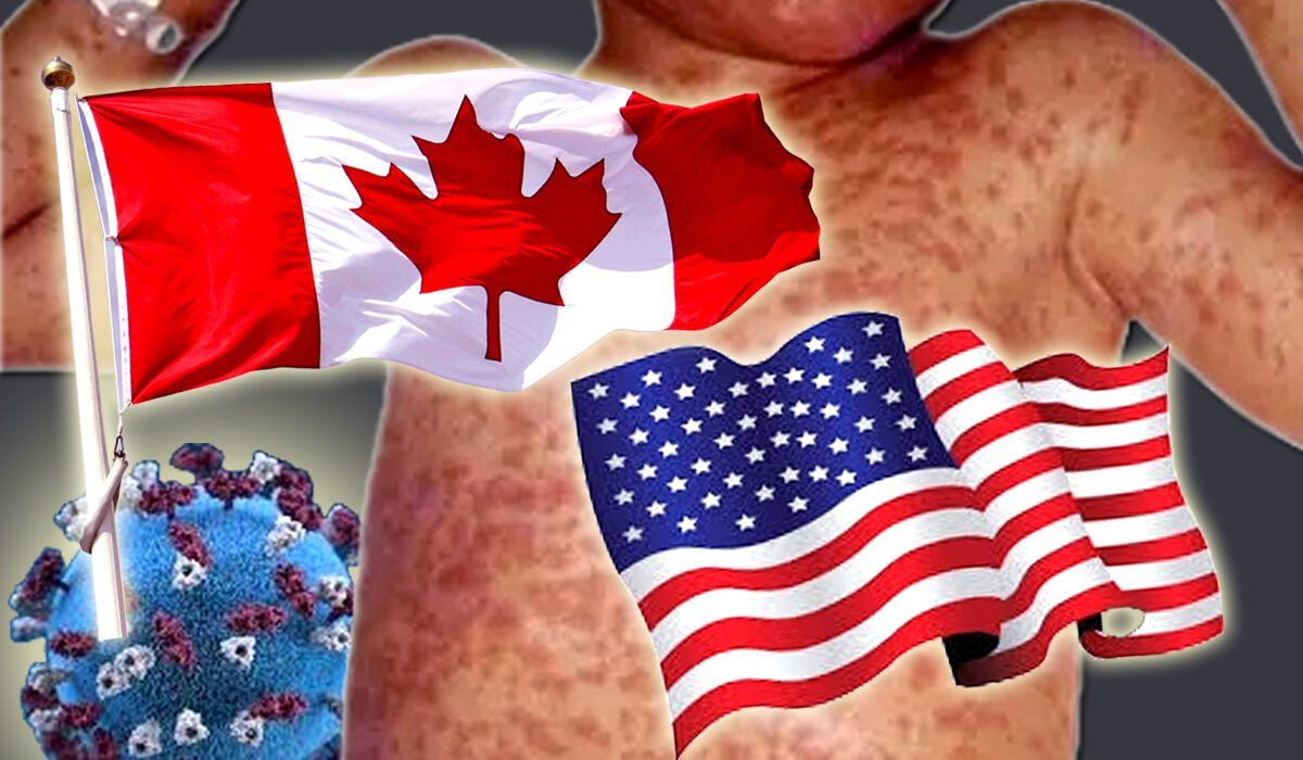 کینیڈا اور امریکہ میں خسرہ