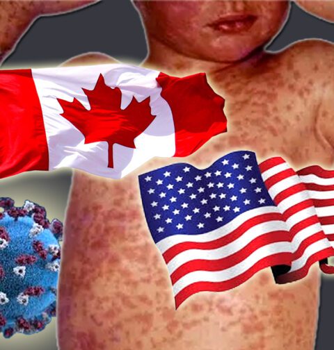 کینیڈا اور امریکہ میں خسرہ