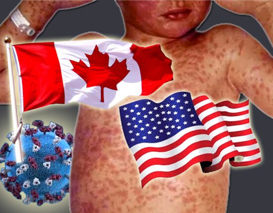 کینیڈا اور امریکہ میں خسرہ