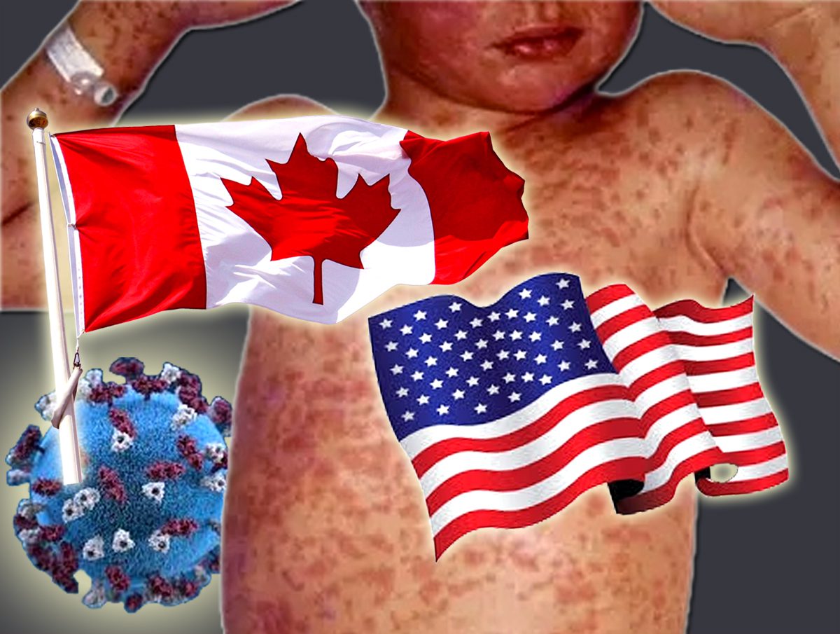 کینیڈا اور امریکہ میں خسرہ