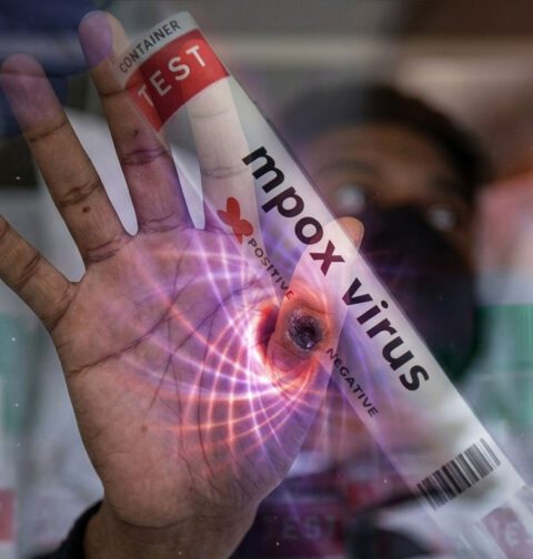 Mpox case confirmed in Karachi, health department issues alert and initiates response