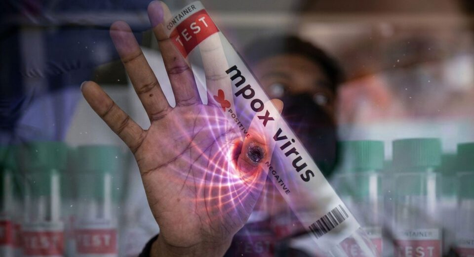 Mpox case confirmed in Karachi, health department issues alert and initiates response