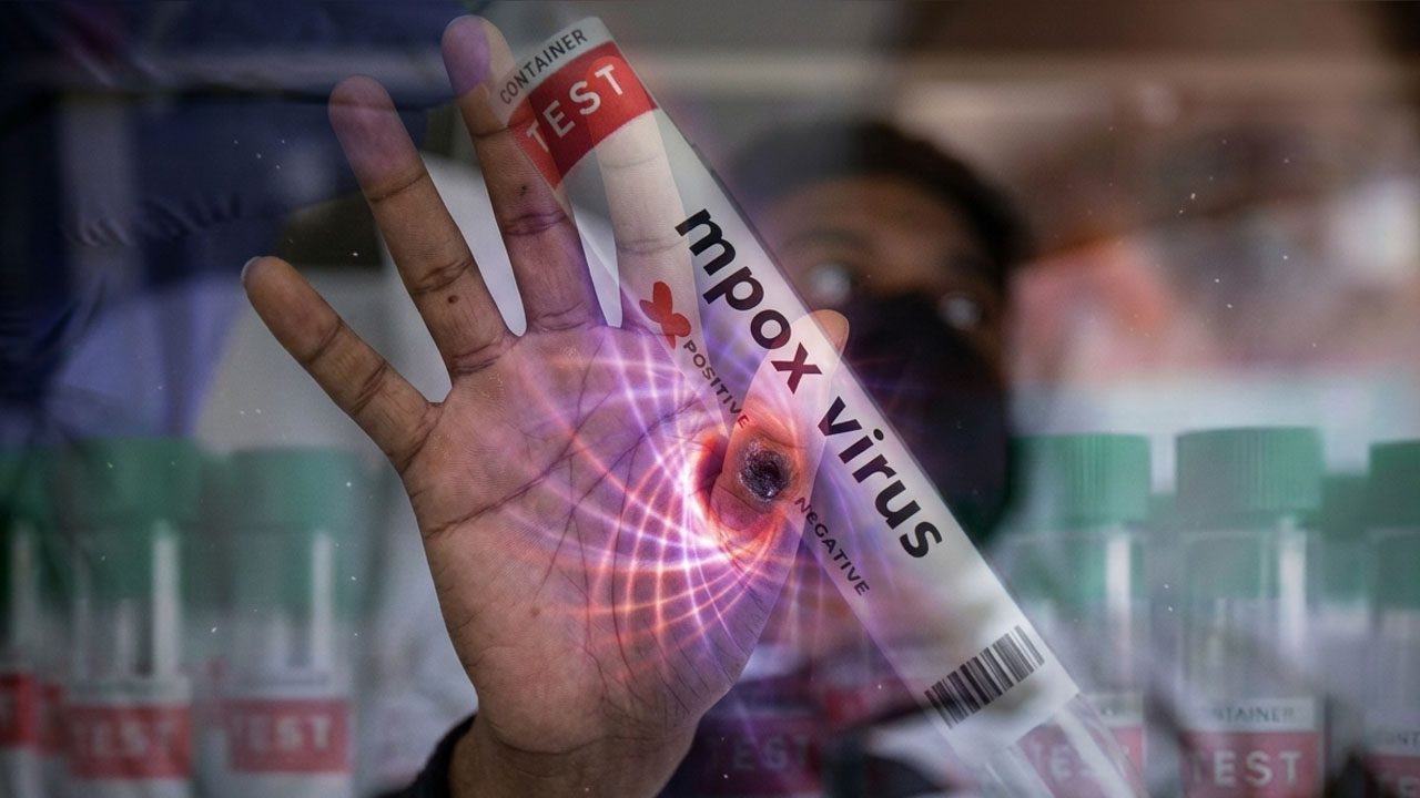 Mpox case confirmed in Karachi, health department issues alert and initiates response