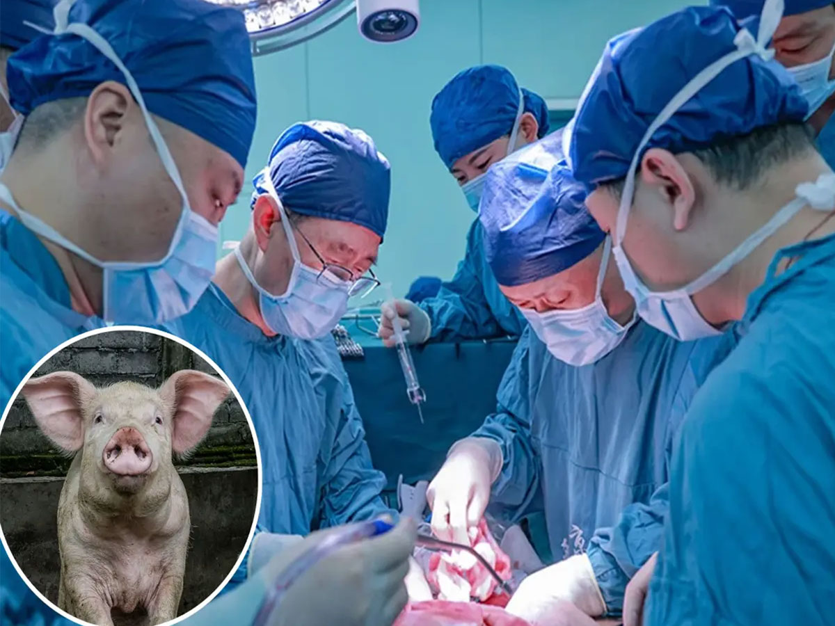 Pig organs transplanted into a human, a major breakthrough in medical science.
